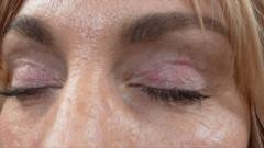 'My eyelids became infected - I was scared to sleep'